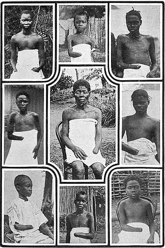 Archival photographs of Congolese children and adults mutilated under the Congo Free State regime, c. 1900–1905.